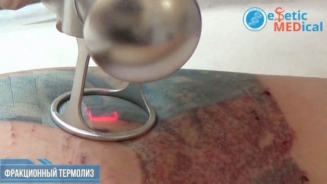 Удаление татуировки в Одессе co2 лазером (фракционный термолиз) смотреть онлайн