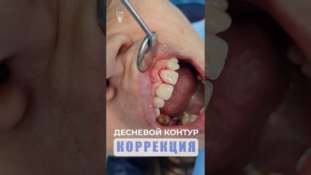 Коррекция десневого контура. Gingival Contour.
