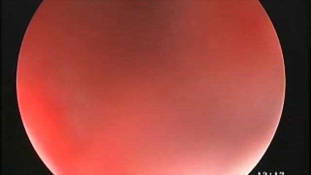 Удаление голосовых связок смотреть онлайн