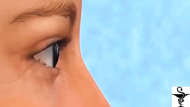 КАК ВЕРНУТЬ МОЛОДОСТЬ!? Лобно-височный лифтинг или блефаропластика? смотреть онлайн