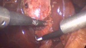 Лапароскопическая  холецистэктомия 2 Эмпиема желчного пузыря