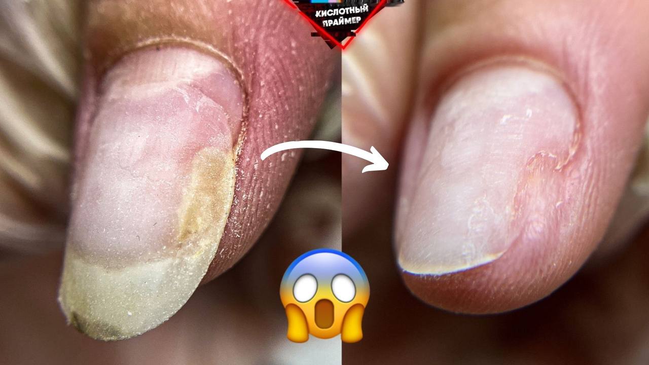 ⚡УДАР ДО ОНИХОЛИЗИСА!? Зачистка онихолизис ногтей на руках? смотреть онлайн
