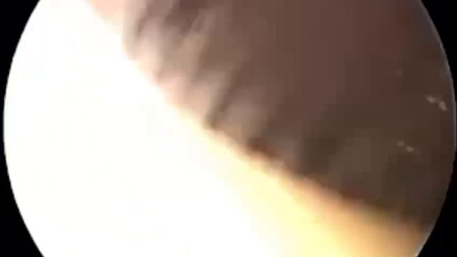 Удаление клеща из уха