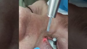 СО2 Лазерное удаление папиллом на веке. С использованием защиты глаз от лазерного воздействия