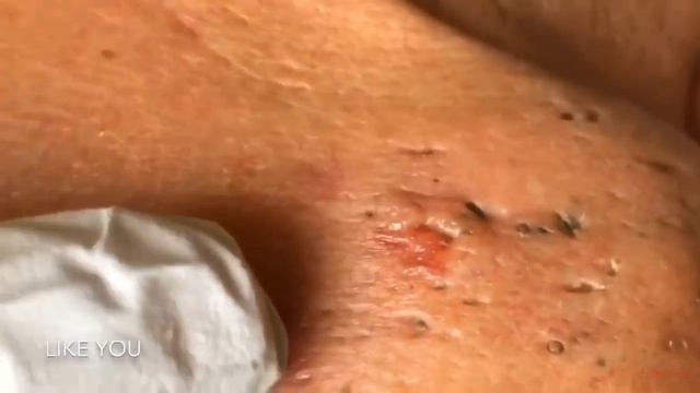 ВНИМАНИЕ!!!!!! Удаление и выдавливание чёрных точек смотреть онлайн