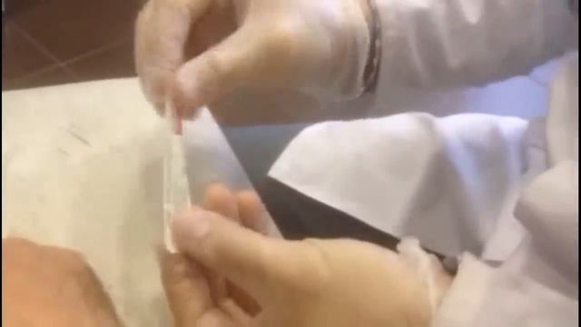 Выкачивание гигромы кисти