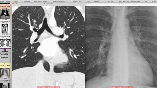 The Pulmonary Hila смотреть онлайн