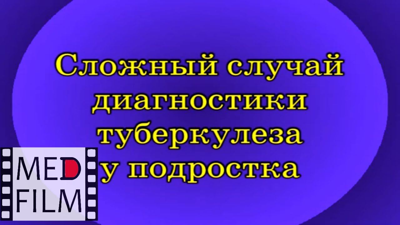 Сложный случай диагностики туберкулеза у подростка © Complicated Case Of Diagnosis Of Tuberculosis