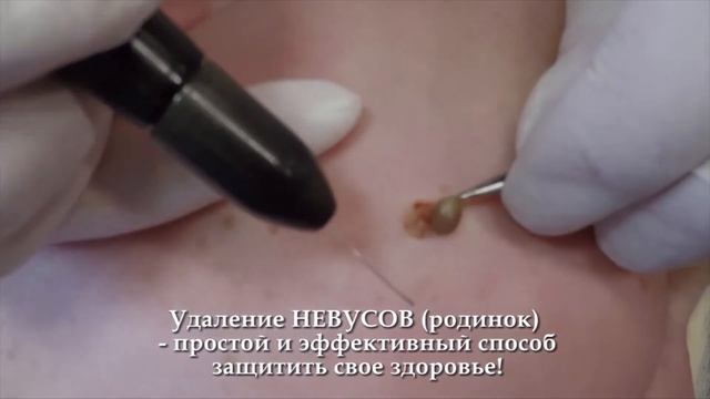 29. Удаление новообразований (невусов) смотреть онлайн