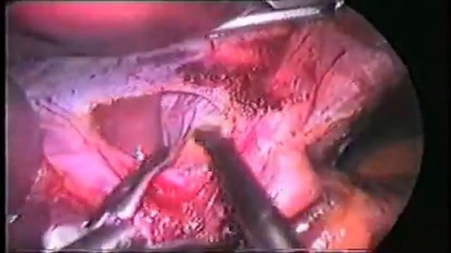 Achalázie 2001 - Achalasia смотреть онлайн