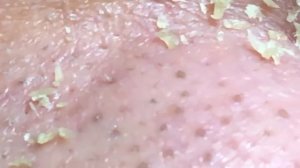 Most Relaxing, Satisfying, Enjoyable; Pluck Acne with a Tweezer 02