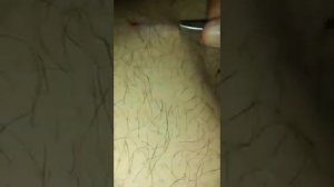 ОГРОМНАЯ ЗАНОЗА ПОД КОЖЕЙ!!! КАК ОНА ТАМ ОКАЗАЛАСЬ???