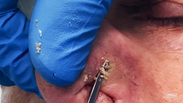 Nose Blackheads Extracted | CONTOUR DERMATOLOGY