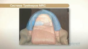 Система Myobrace