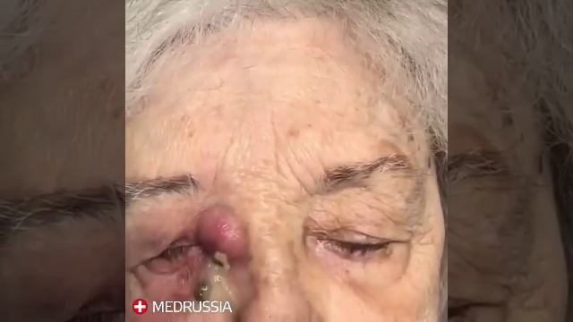Вскрытие гнойника смотреть онлайн