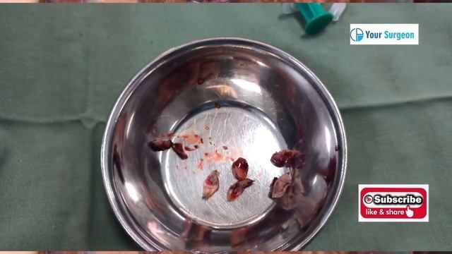 PILES PICTURE IMAGES - HOW DOES IT LOOK ? बवासीर - कैसा दिखता है ? PICS смотреть онлайн