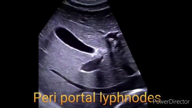 Several enlarged lymph nodes in the hilum of the liver.S/o Peri portal lyphnodes. смотреть онлайн