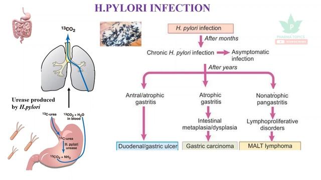 Anti H.pylori drugs - GIT Pharmacology - Part 8 смотреть онлайн