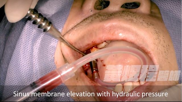 Hydraulic Sinus Lift With Simultaneous Implant Placement