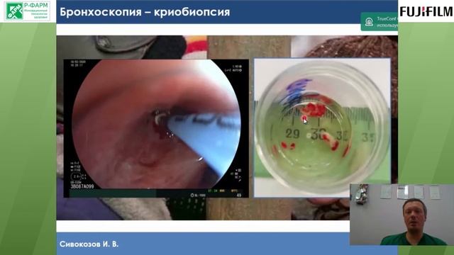 Современные возможности респираторной эндоскопии. И. В. Сивокозов смотреть онлайн