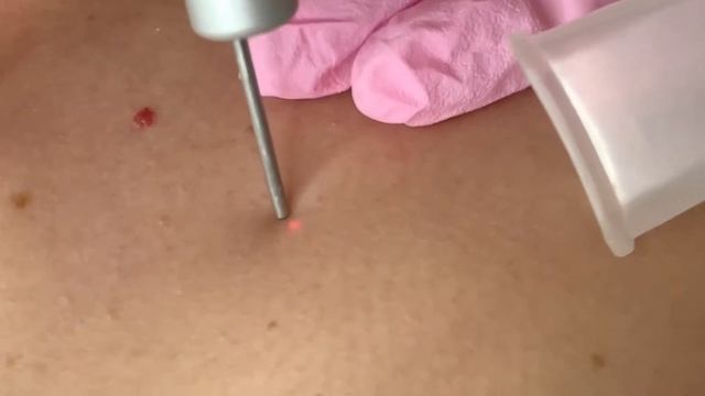 Удаление множественных кератом смотреть онлайн