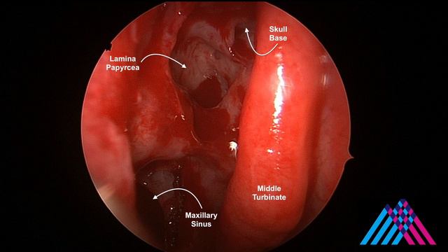 Functional Endoscopic Sinus Surgery (FESS) for sinusitis смотреть онлайн