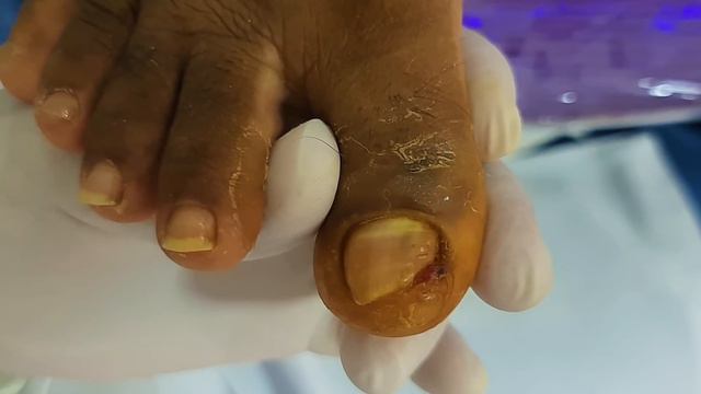 VOCÊ SOFRE COM A UNHA ENCRAVADA? (DO YOU SUFFER WITH YOUR INGROWN NAIL?) - PODÓLOGO MAURÉLIO смотреть онлайн