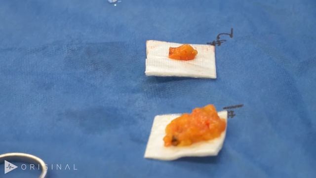 Skin Sparing Mastectomy with Sentinel Node Biopsy by Sarah A. McLaughlin, MD | Preview смотреть онлайн