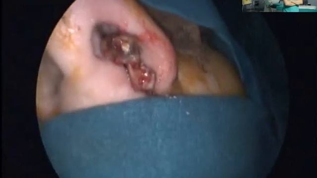 Гигантский полип,пломба в гайморовой пазухе.Эндоскопическое удаление смотреть онлайн