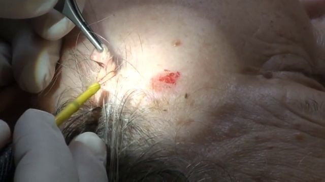 Удаление кератомы и мягкой фибромы смотреть онлайн