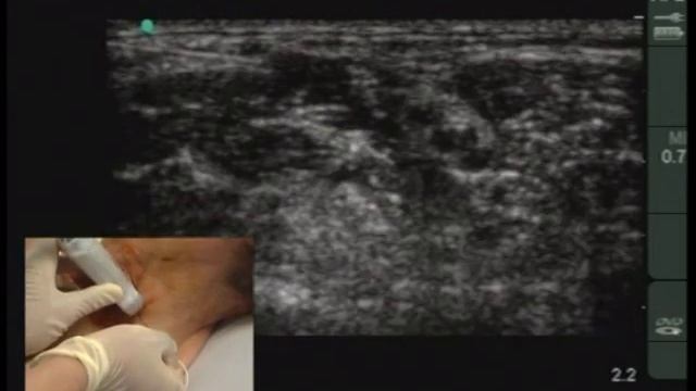 Межлестничная проводниковая блокада плечевого сп смотреть онлайн