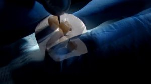 Препарирование кариозных полостей по Блэку 1- 5 класс Блек