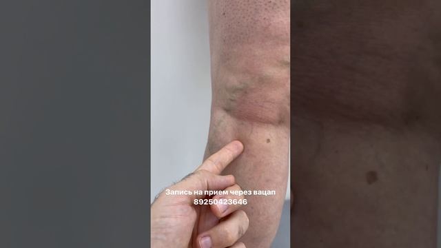 Варикоз на ноге у женщины. Как лечить варикоз. Лечение варикоза. Флеболог Москва. Флеболог смотреть онлайн