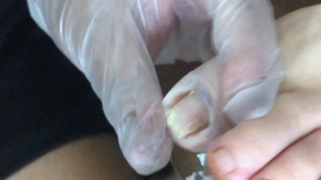 The shoes are too small and the nails are damaged, the pedicure master treats them【Foot Scalpel】 смотреть онлайн