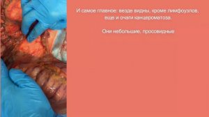 Как выглядит непроходимость кишечника (стеноз) и канцероматозглазами хирурга