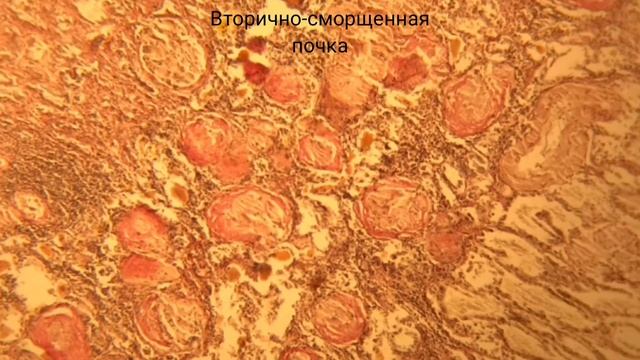 Вторично-сморщенная почка смотреть онлайн