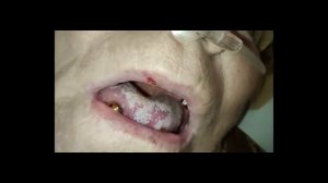 Грибок полости рта. Как выглядит кандидоз.