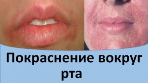 Покраснение вокруг рта