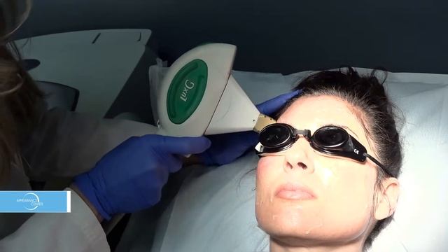 Patient Experience with Intense Pulsed Light (IPL) Photo Facial смотреть онлайн