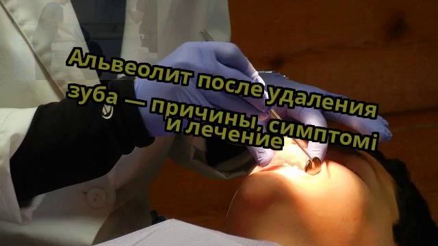 Альвеолит после удаления зуба — причины, симптомі и лечение смотреть онлайн