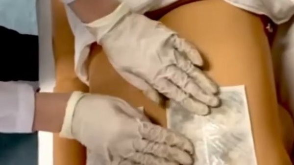 Применение горчичников