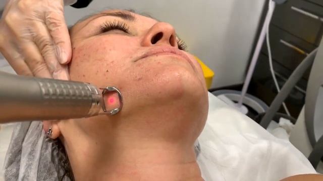 Фракционное сверление кожи, дриллинг, лазерное омоложение кожи шеи и лица смотреть онлайн