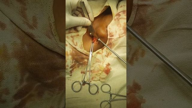 Cervical Lymph Node Biopsy ; level Vb смотреть онлайн