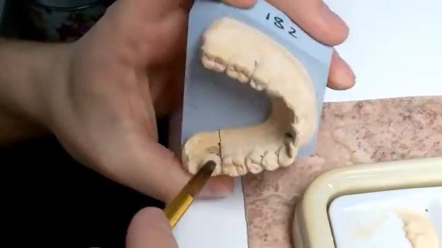 металлокерамика на имплантах винтовая фиксация. смотреть онлайн