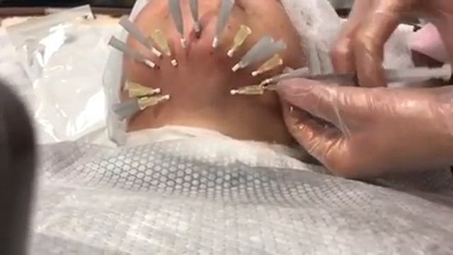 Подтяжка подбородка Ирина Башура смотреть онлайн