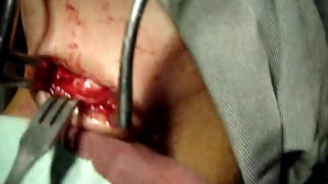 Submental LN excision смотреть онлайн
