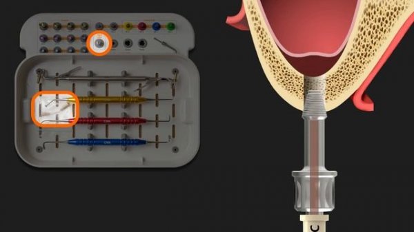Набор для синус лифтинга INNO Sinus Kit MFS