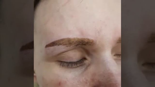 Лазерное удаление неудачного татуажа бровей смотреть онлайн