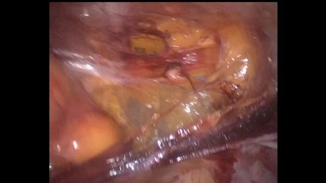 Лапароскопическая герниопластика по поводу ущемленной паховой грыже (incarcerated groin hernia). смотреть онлайн