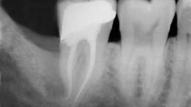 Impacted Tooth Removal смотреть онлайн